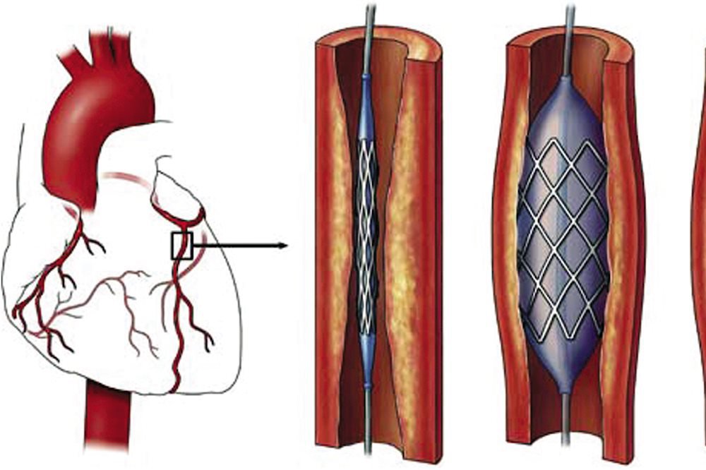 Đặt stent mạch vành được bao lâu? Tái hẹp mạch vành thì làm thế nào?