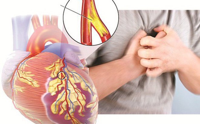 Cảnh giác nhồi máu cơ tim do co thắt động mạch vành