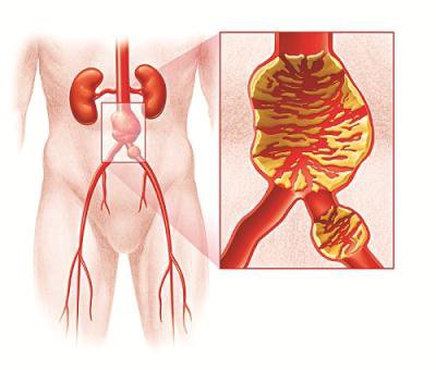Biến chứng và nguy cơ vỡ túi phình động mạch chủ bụng