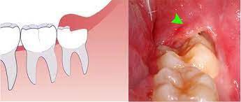 Lợi trùm răng khôn hàm dưới gây khó chịu nên làm gì?