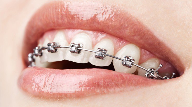 Nữ giới niềng răng, có 4 răng khôn nên làm gì?