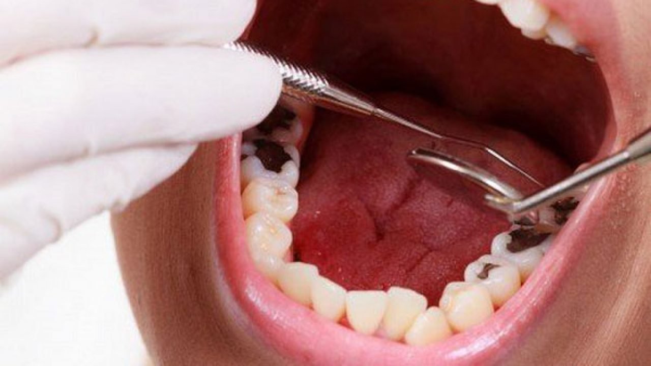 Răng sâu đen có nên bọc răng sứ không?