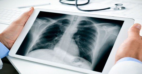 Kết quả chụp Xquang phổi như thế nào là nguy hiểm?